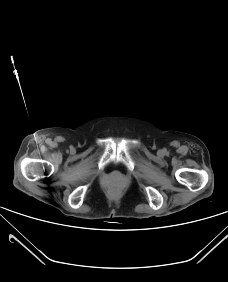 sinh thiết u xương qua ct scan p2